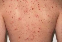 Alerta nacional por sarampión: en Salta se refuerza la vigilancia epidemiológica