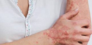 Salud Pública detectó en Orán los primeros casos de lepra de 2026