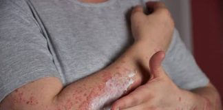 Suman 6 los casos diagnosticados de lepra en Salta